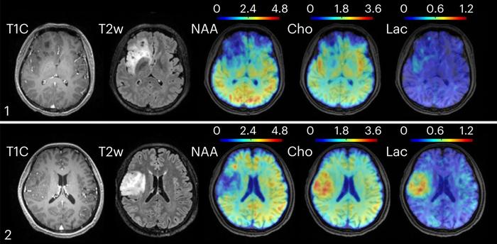 Fast Metabolic MRI Offers New Insights into Neurological Disorders