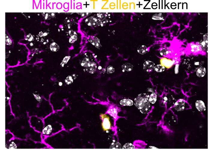 Immune Response Identified as Early Driver in Spastic Paraplegia