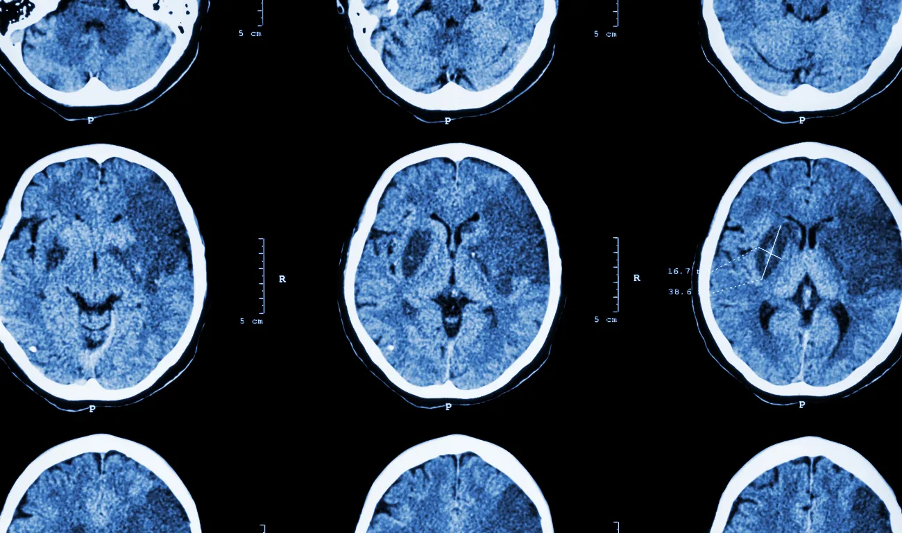 New Multidimensional Framework Set to Revolutionize Brain Injury Diagnosis